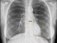 Intelligenza Artificiale a supporto del reparto di Diagnostica degli ospedali di Pesaro e Fano